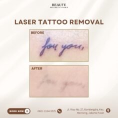 Tattoo lama bukan berarti harus selamanya.

Dengan Laser Tattoo Removal, warna t…