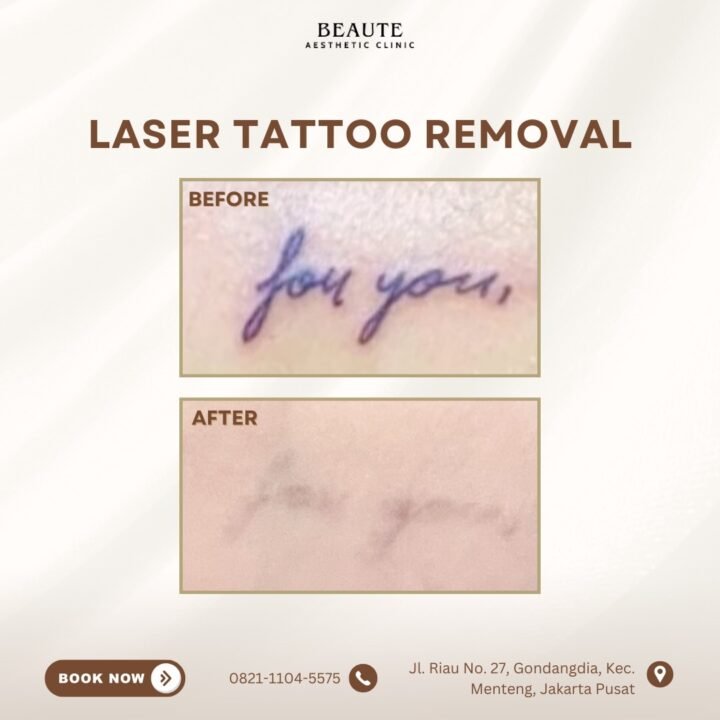 Tattoo lama bukan berarti harus selamanya.

Dengan Laser Tattoo Removal, warna t…